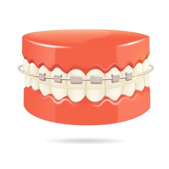 This is a detailed model showcasing a mouth that has braces fitted on it vector
