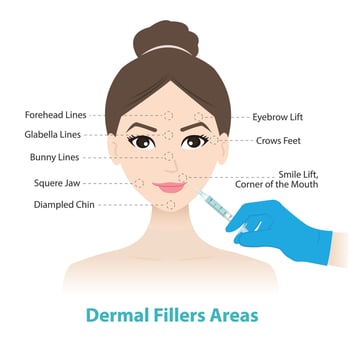 Dermal fillers treatment injection areas on woman face illustration. Filler inject under the skin to restore lost volume, smoothen wrinkles, enhance facial contours. Medical and beauty concept. vector