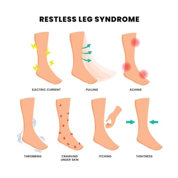 Different types of restless leg syndrome poster, medical banner infographic with electric current, pulling, aching, throbbing, crawling under skin, itching, tightness. Feet foot periodic pain ache. vector