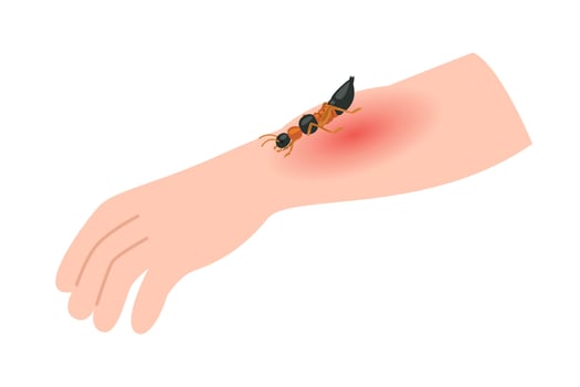 Paederus beetle on skin make skin allergy concept vector