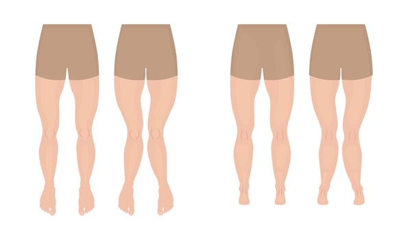 Genu valgum, genu varum and normal legs, front and back view comparison vector