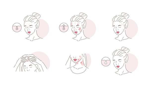 Beauty Girl Have Acne on her Face, Neck and Hair Skin. Blackheads, Whiteheads, Post Acne and other Acne Skin Problems vector